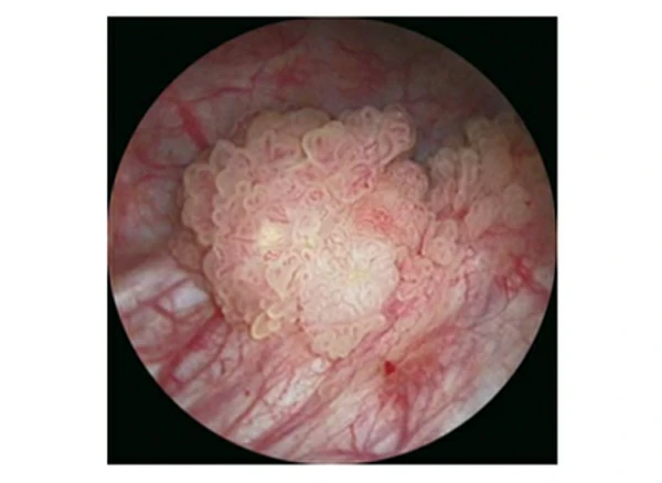 reseccion transuretral de tumor vesical