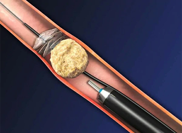 Ureterolitotricia láser ureterolitotricia laser