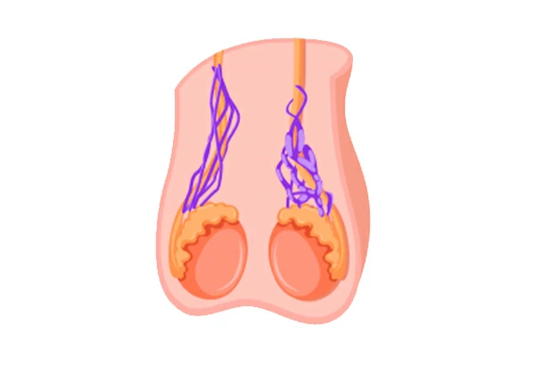 Cirugía de varicocele cirugia de varicocele