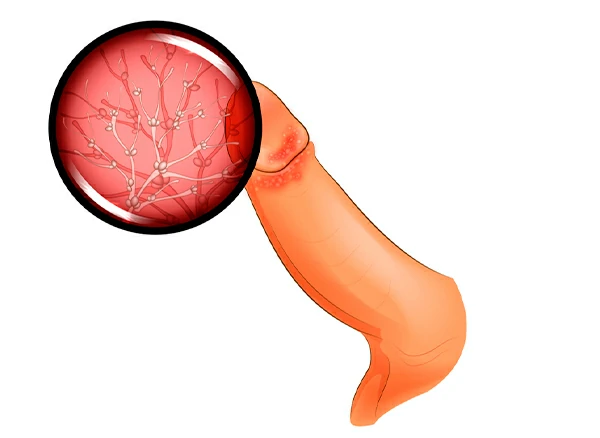 balanitis