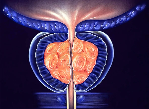 crecimiento prostatico