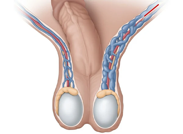varicocele